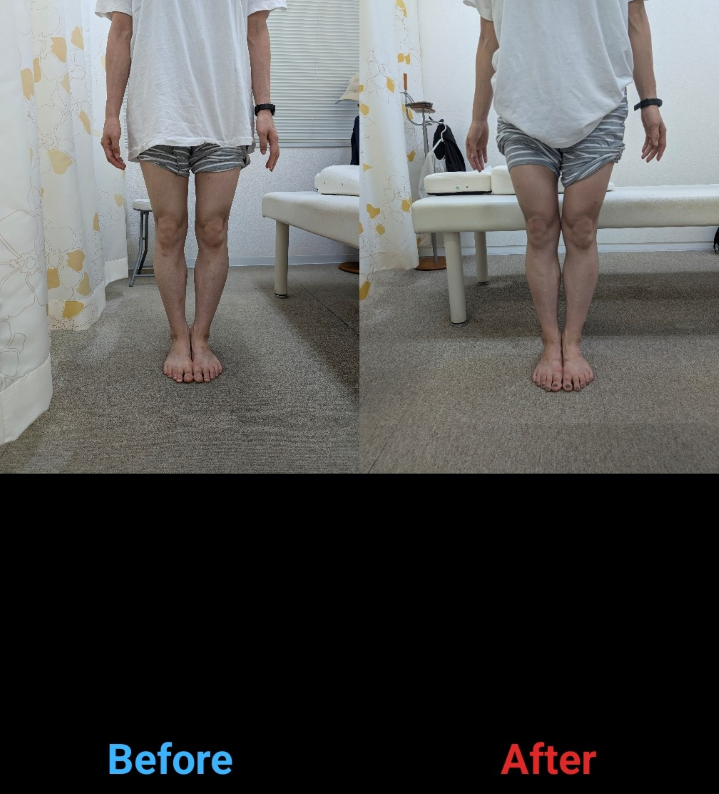 O脚矯正と体操指導により、膝がピッタリ付くように。